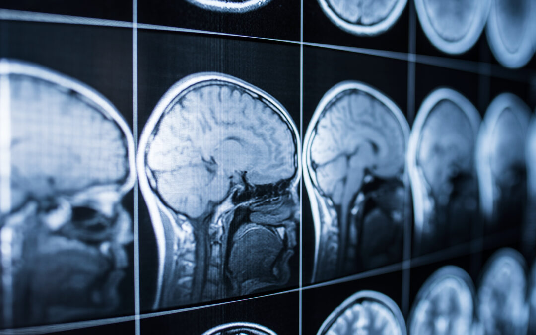 Brain Injury Awareness Month